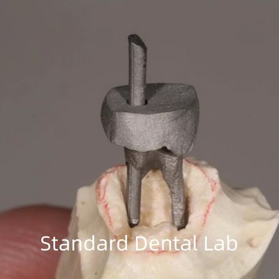 購入 歯科修復 メタルポストとコア・クラウン 完璧にフィット オンライン製造