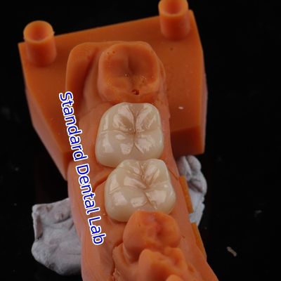 購入 全コントール ザルコニア 冠 透明性 3D PRO ポーセリア オーバーレイ 標準歯科ラボ オンライン製造