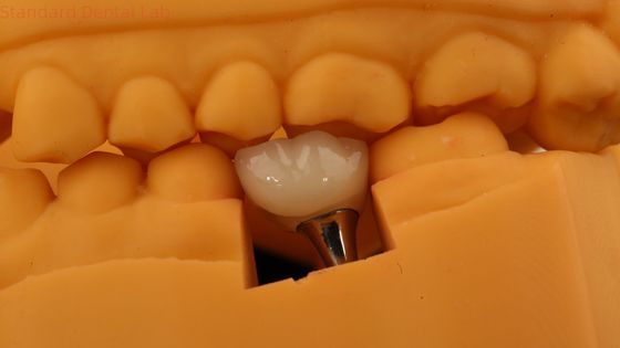 購入 3Dプリントモデル付きの歯科PFM オンライン製造