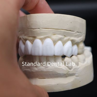 歯科王冠 診断用ワックスアップ 中国歯科ラボからの高い美学