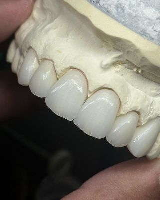 透明性層ジルコニアクラウン 最適機能と自然な美学