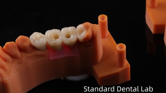 歯科インプラントクラウンとPFZポルセラン層ジルコニア5年保証と3Dプリントモデル