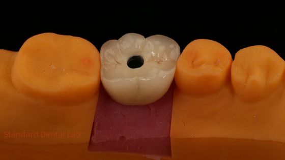 歯科ラボからのシールドリテインされたPFZポルセラン層ジルコニア歯科インプラントクラウン ISO FDA CE認定 5 年間の保証