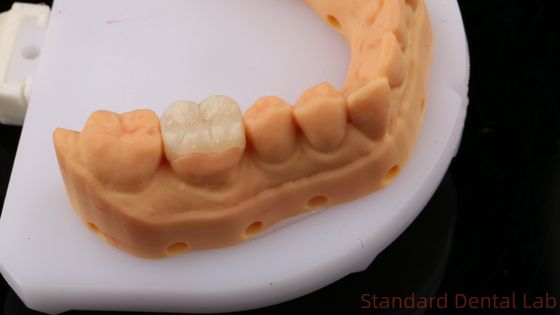 透明性 Zirconia 歯科 インレイ オンレイ クラウン 自然腔の形を回復 / 標準歯科ラボ
