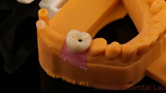 歯科インプラント スクロール 保持冠 PFZ ポルセラン 3D プリントモデル付き 層状ジルコニア