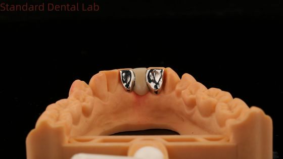 歯科PFM メリーランド・ブリッジ 高級エステティック FDA 認定 ビタ・ポルセリアン 中国歯科ラボ
