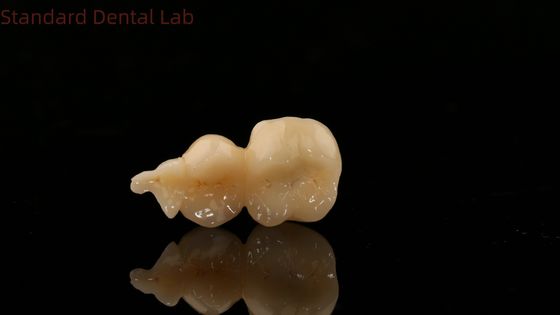 3Dプリントモデル付き 歯科デジタルフルジルコニアクラウン SDL歯科ラボ ジルコニアオンレイ