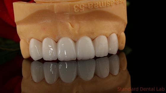 全コントール ザルコニア 冠 透明性 3D PRO ポーセリア オーバーレイ 標準歯科ラボ
