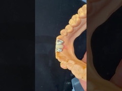 歯科歯科 PFM メリーランド・ブリッジ 高級エステティック FDA認定