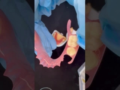 3Dプリントモデル 高エステティック 歯科 TCS バルプラスト 柔軟性のある部分歯科 歯科ラボ